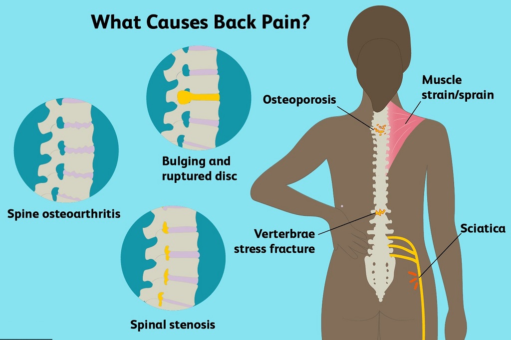 When should I see a doctor for back pain